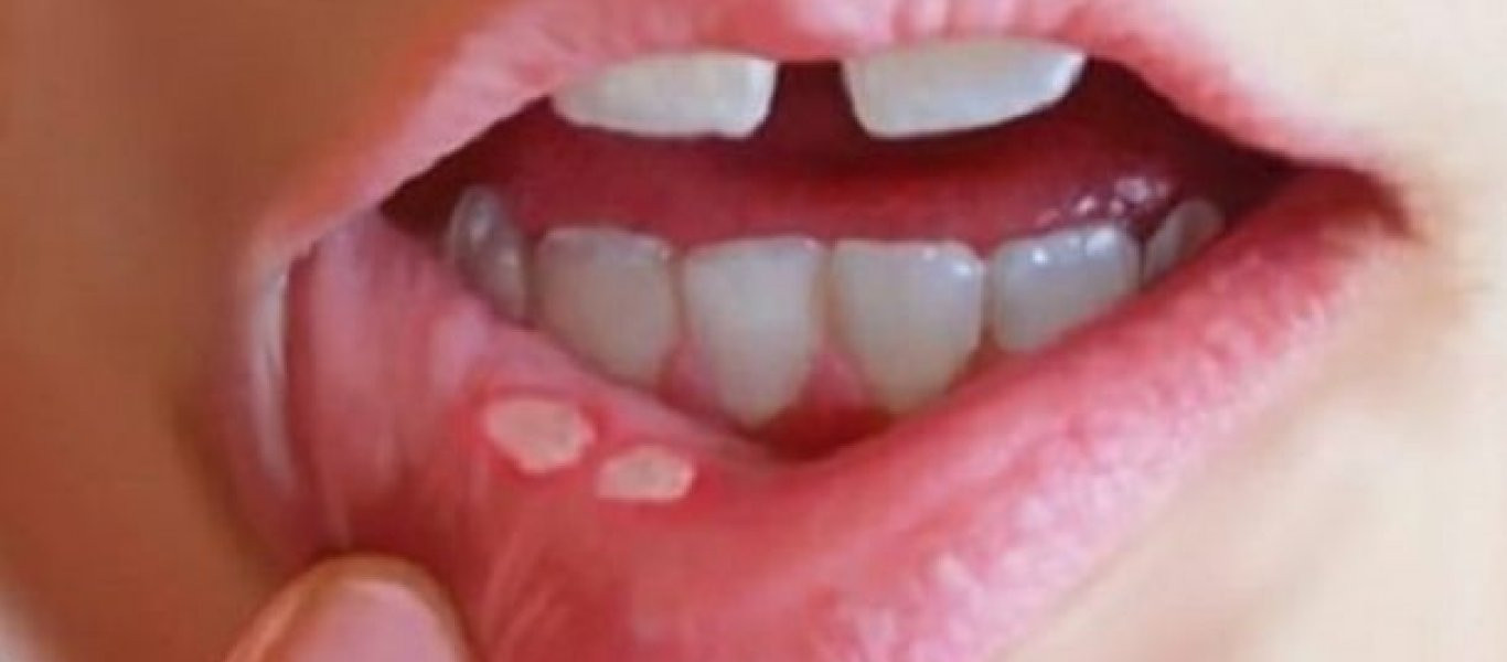 Ποιες παθήσεις μπορεί να κρύβουν οι άφθες στο στόμα